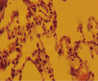 ОТСУТСТВИЕ ПАТОЛОГИЧЕСКИХ ИЗМЕНЕНИЙ И КАЛЬЦИФИКАТОВ ПРИ ВВЕДЕНИИ АЛЛОГЕННОГО ГАП